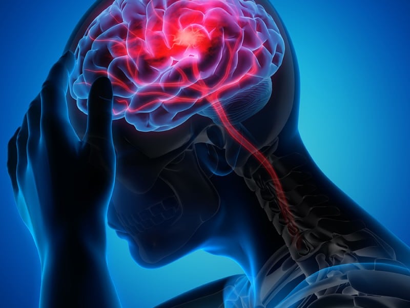 Wellness Watch: Know the signs of stroke and steps to prevent it